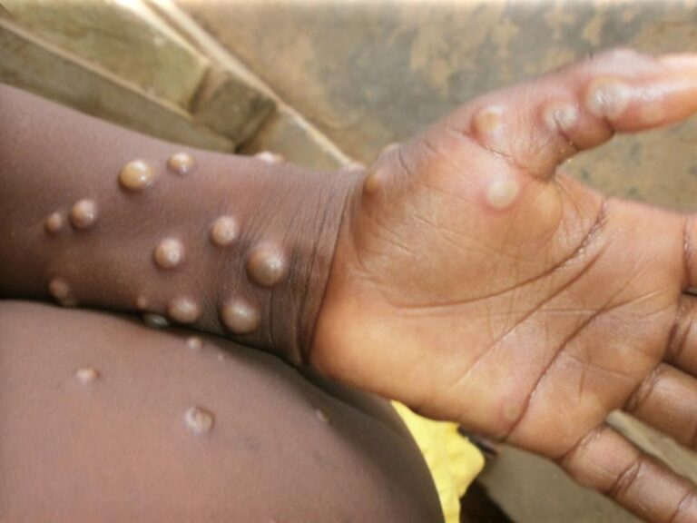 Clade I Mpox in Central and Eastern Africa – CDC Clade I Mpox in Central and Eastern Africa – CDC