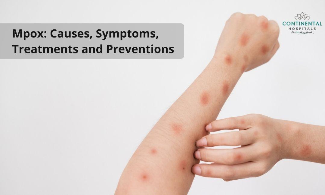 Public Health Strategies to Mitigate mpox Spread in Affected Regions